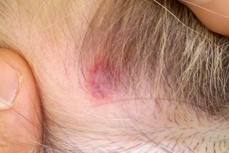 zecca rostro infezione malattia